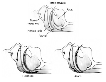 apnee obstructiva de somn (obstructive) apnee obstructiva de somn