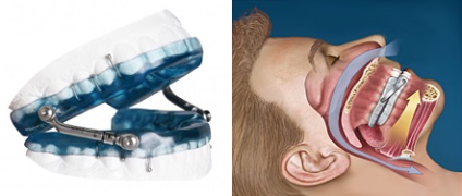apnee obstructiva de somn (indicele de apnee hipopnee) apnee obstructiva de somn