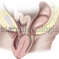 Omiterea uterului (prolapsul uterin) Omiterea uterului