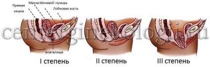 ptoza uterin (moleșit) Omiterea uterului