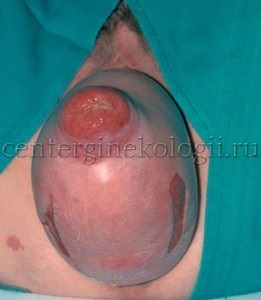 Omiterea uterului (uter) Omiterea uterului