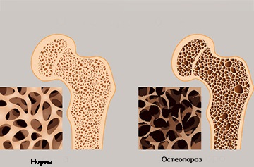 tumoare suprarenală - simptome, diagnostic, tratament (tumoare) tumoare suprarenală - simptome, diagnostic, tratament