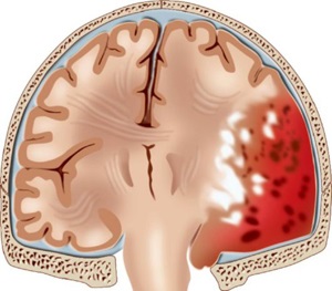 Остър и хроничен епидурален хематом на мозъка и ефектите от лечението