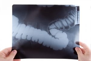complicatii de perforare esofagian, prevenirea (esofagiene) Perforarea complicațiilor esofagului, prevenirea