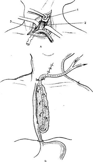 Perforarea de col uterin simptome esofag, cauze, diagnostic si tratament