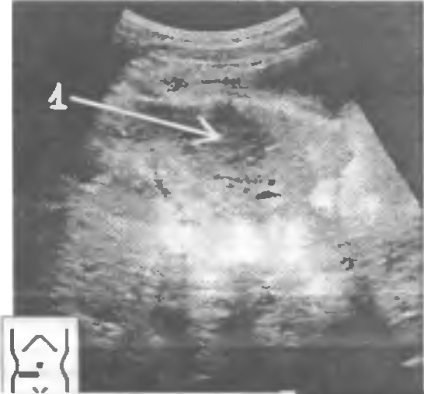 Are ultrasunete apendicita (ultrasunete) Are ultrasunete apendicita