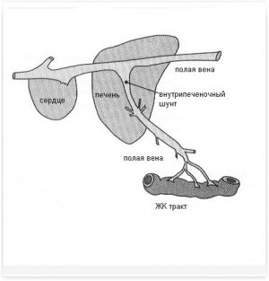 shunts portosistemice (conexiuni vasculare anormale) shunts portosistemice