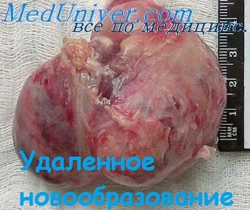 Mărimea și structura lipoame mediastinali (dimensiuni) Mărimea și structura lipoame mediastinale
