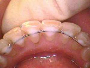 Retainers după bretele ca purtarea (bretele) Contenție după acolade uzura