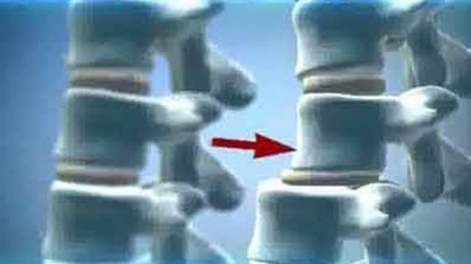 Deplasarea simptomelor toracice și tratament (simptome) ale vertebrelor Deplasarea Simptomele vertebrelor toracice și tratament