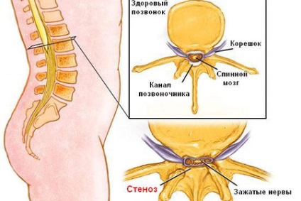 vertebral lombar stenoza si a coloanei vertebrale cervicale (lombare) lombare stenoza spinarii si a coloanei vertebrale cervicale