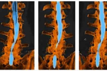 vertebral lombar stenoza si a coloanei vertebrale cervicale (stenoza) lombare stenoza spinarii si a coloanei vertebrale cervicale