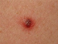 nevilor reliefata - corp, partea din spate, valoarea a devenit de culoare roșie, un copil, o fotografie (spate) nevilor reliefata - corp, partea din spate, valoarea a devenit de culoare roșie, o fotografie copil