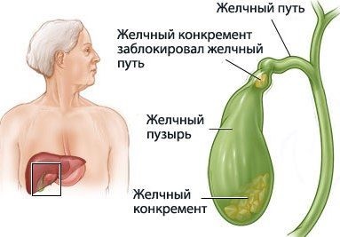 Colelitiaza (violarea metabolismului colesterolului) colelitiază
