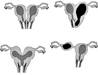 Anomalii ale organelor genitale feminine - cauze, simptome, diagnostic și tratament