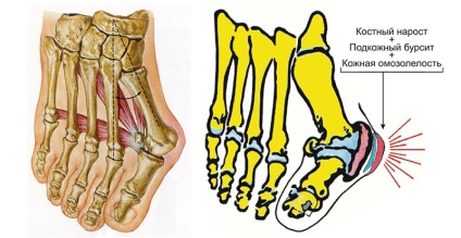 site-ul Tselebnik medicina tradițională - tratamentul hallux valgus deget de la picior mare (ca tratament pentru hallux valgus) site-ul Tselebnik medicina tradițională - tratamentul hallux valgus deget mare