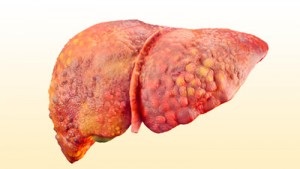 Ciroza hepatica - este cancer sau nu