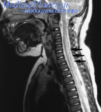 Периодично хипоперфузия гръбначния мозък