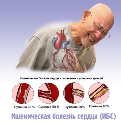 Simptomele bolii coronariene, diagnostic diferențial, tratament, semnele timpurii ale bolii coronariene
