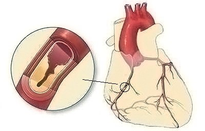 Simptomele bolii coronariene, diagnostic diferențial, tratament, semnele timpurii ale bolii coronariene