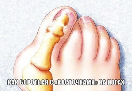 Cum să se ocupe cu „oase“, pe jos (degetul mare) Cum să se ocupe cu „oasele“ la picioare