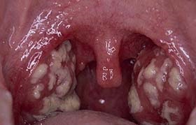 Cum de a elimina puroiului din amigdalele acasă și curăța propriile lor amigdale