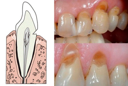 Defectul în formă de pană a dinților este de a ști despre tratament