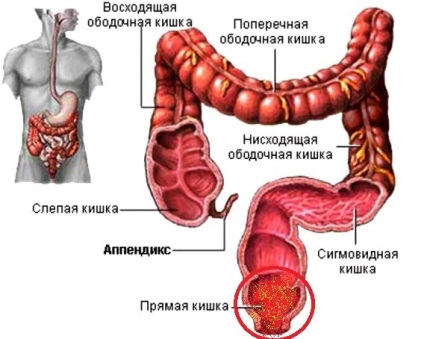 simptome proctita, tratament, remedii populare, dieta