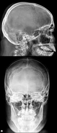 Razele X ale craniului, care determină modul de a face