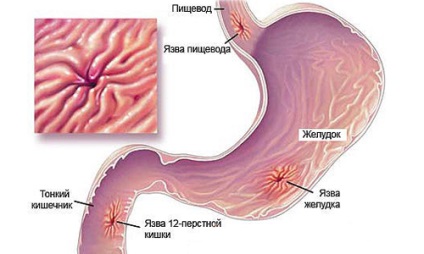 semințe de in în gastrită și ulcer gastric
