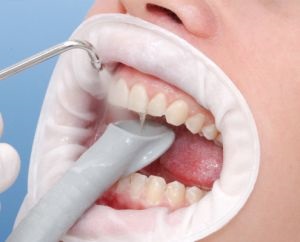 optrageyt gag dentare (OptraGate) - modul de utilizare a retractor