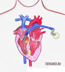 instalarea stimulator cardiac