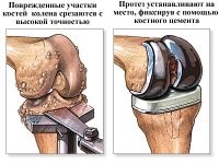 Tratamentul osteoartritei membrelor inferioare