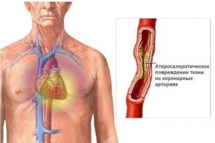 Ischemia semnelor și simptomelor de ischemie cardiacă la femei și bărbați