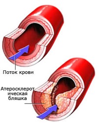 Cum sa scapi de ateroscleroza - tratament de inima
