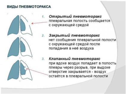 Cum să recunoască simptomele de tuberculoză și primele semne ale unui adult în stadiile incipiente