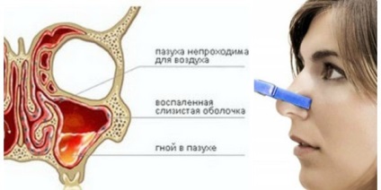 видове простудни синузит, симптоми и лечение, профилактика