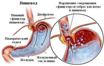 Tratamentul esofagitei de reflux prin remedii populare