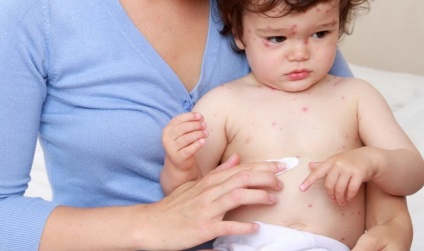 O formă ușoară de varicela la copii si adulti - simptome, tratament, ca veniturile