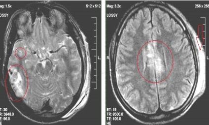 RMN expert IRM in diagnosticul de leziuni cerebrale traumatice