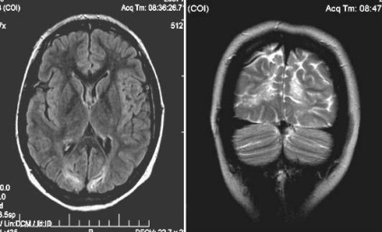 RMN expert IRM in diagnosticul de leziuni cerebrale traumatice