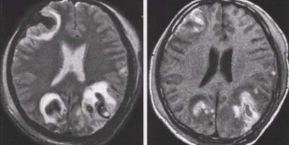 RMN expert IRM in diagnosticul de leziuni cerebrale traumatice