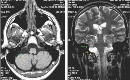 RMN expert IRM in diagnosticul de leziuni cerebrale traumatice