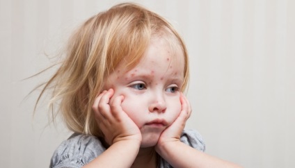 Varicela sunt ușoare în simptome și tratament pentru copii