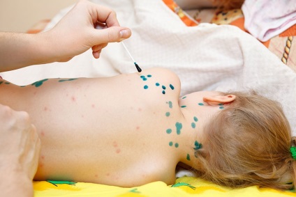 Varicela sunt ușoare în simptome și tratament pentru copii