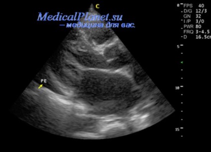 Lichidul pericardic