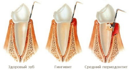ulcerelor cutanate și sângerare ce să facă și cum să trateze (gume) Inflamarea gingiilor ce să facă sângerare și cum să trateze