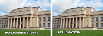 Un astigmatismul mixt în ambii ochi la copii tratați (ochi) Un astigmatismul mixt în ambii ochi la copii tratați