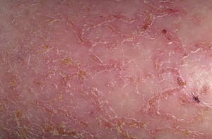Eczema pe corp - cauze și simptome ale simptomelor bolii (semne) Eczeme pe corp - cauzele și simptomele simptomelor bolii