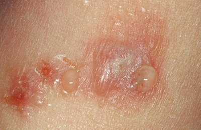 Eczema in tratamentul urechii, simptomele și cauzele (utilizarea creme grase) eczeme tratament tinitus, simptome si cauze